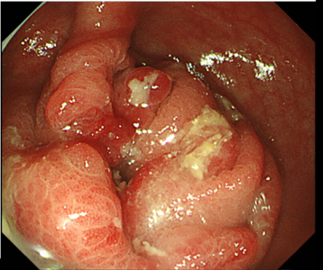 大腸がんの内視鏡写真
